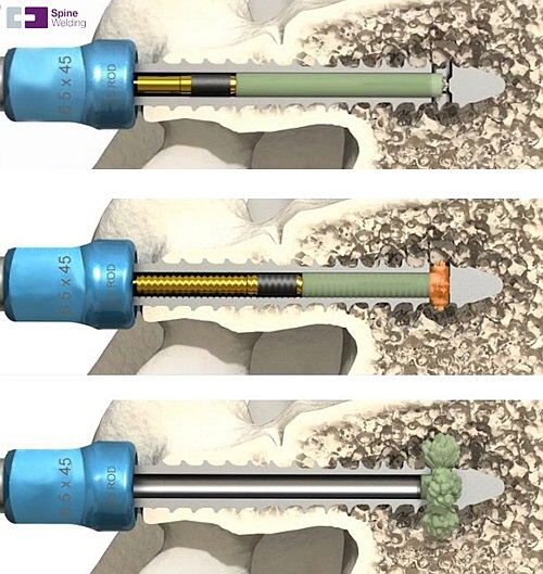 Samaplast - SpineWelding Elaris Screw Process Samaplast - SpineWelding Elaris Screw Process